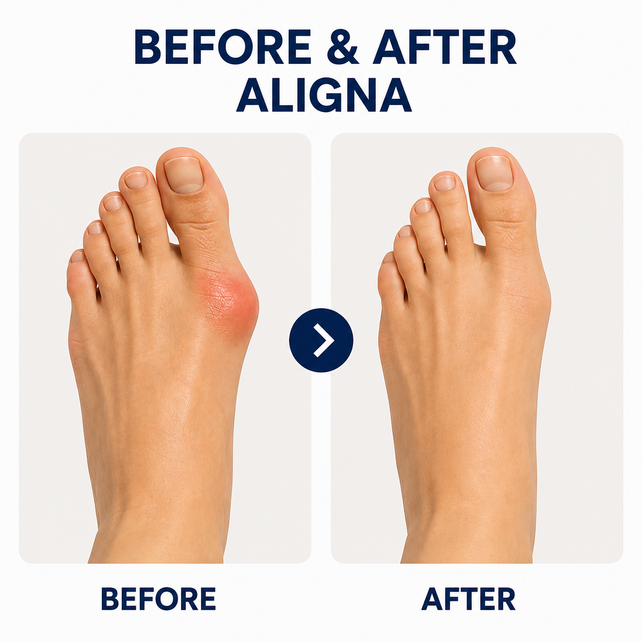 Aligna Adjustable Bunion Corrector
